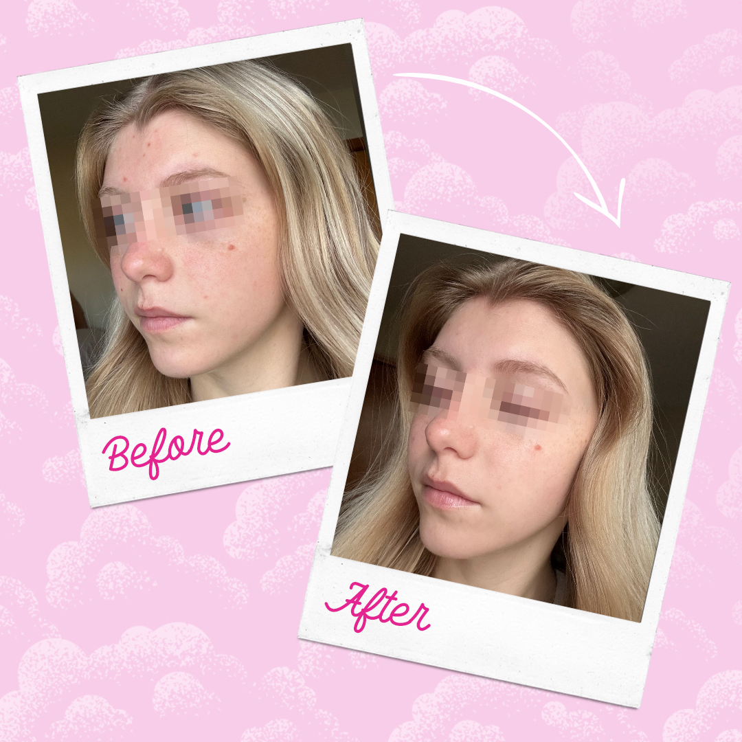 Silver Infused MakeUp Eraser PRO Acne Prone Skin