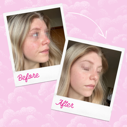 Silver Infused MakeUp Eraser PRO Acne Prone Skin